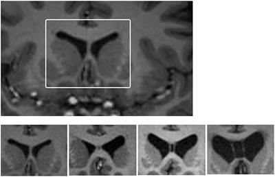 Examining for Cavum Septum Pellucidum and Ventricular Enlargement in Retired Elite-Level Rugby League Players